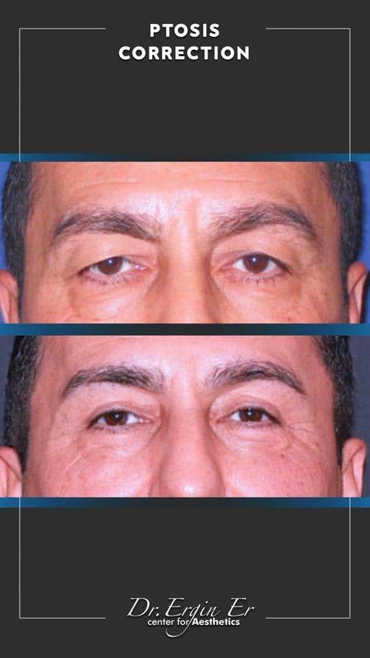 DR ERGIN ER ISTANBUL RESULTS SURGERY 18