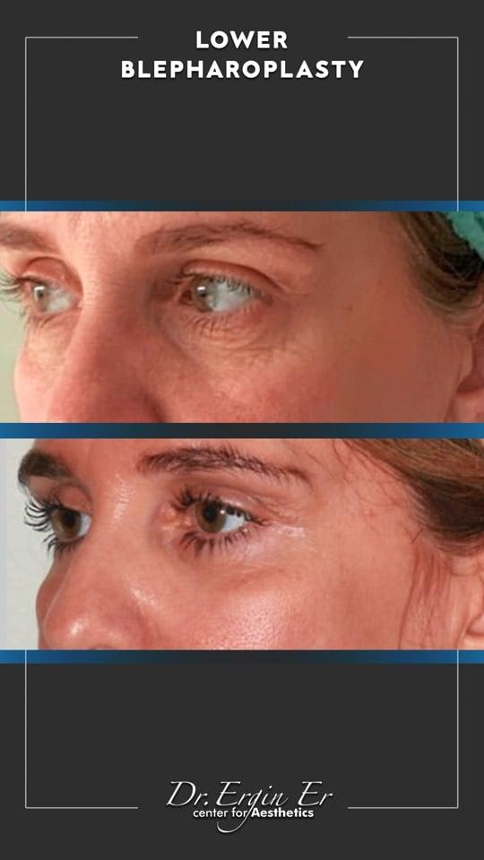 DR ERGIN ER ISTANBUL RESULTS SURGERY 16
