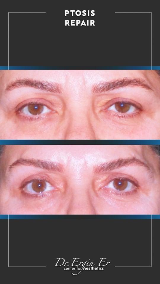 DR ERGIN ER ISTANBUL RESULTS SURGERY 11