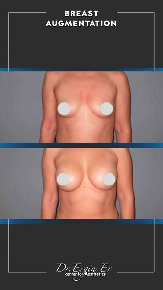 DR ERGIN ER ISTANBUL RESULTS SURGERY 19