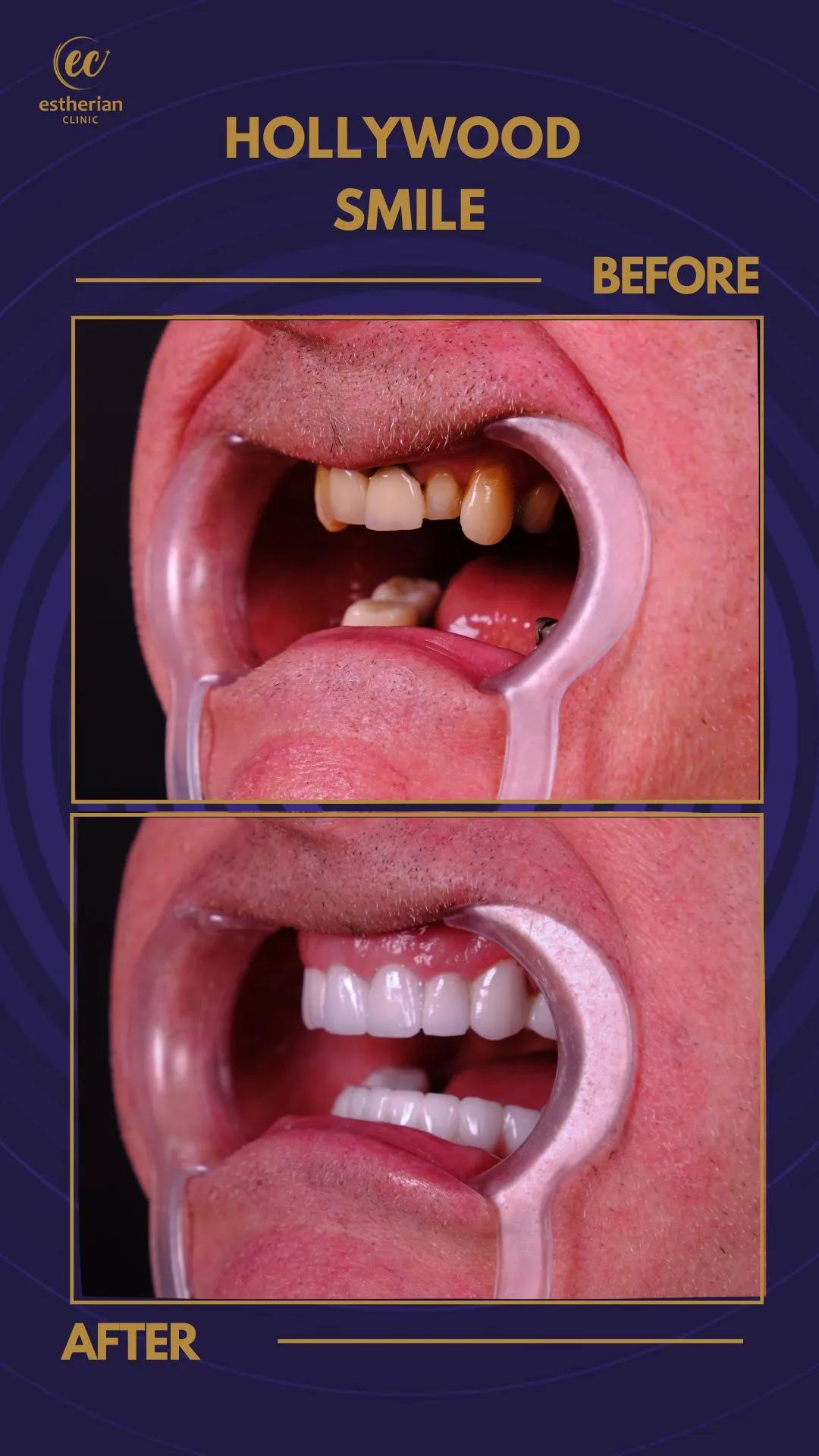 Cosmetic surgery Istanbul Before and after 7