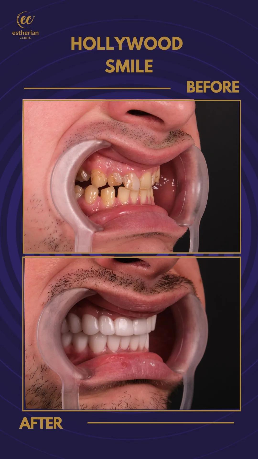 Cosmetic surgery Istanbul Before and after 8