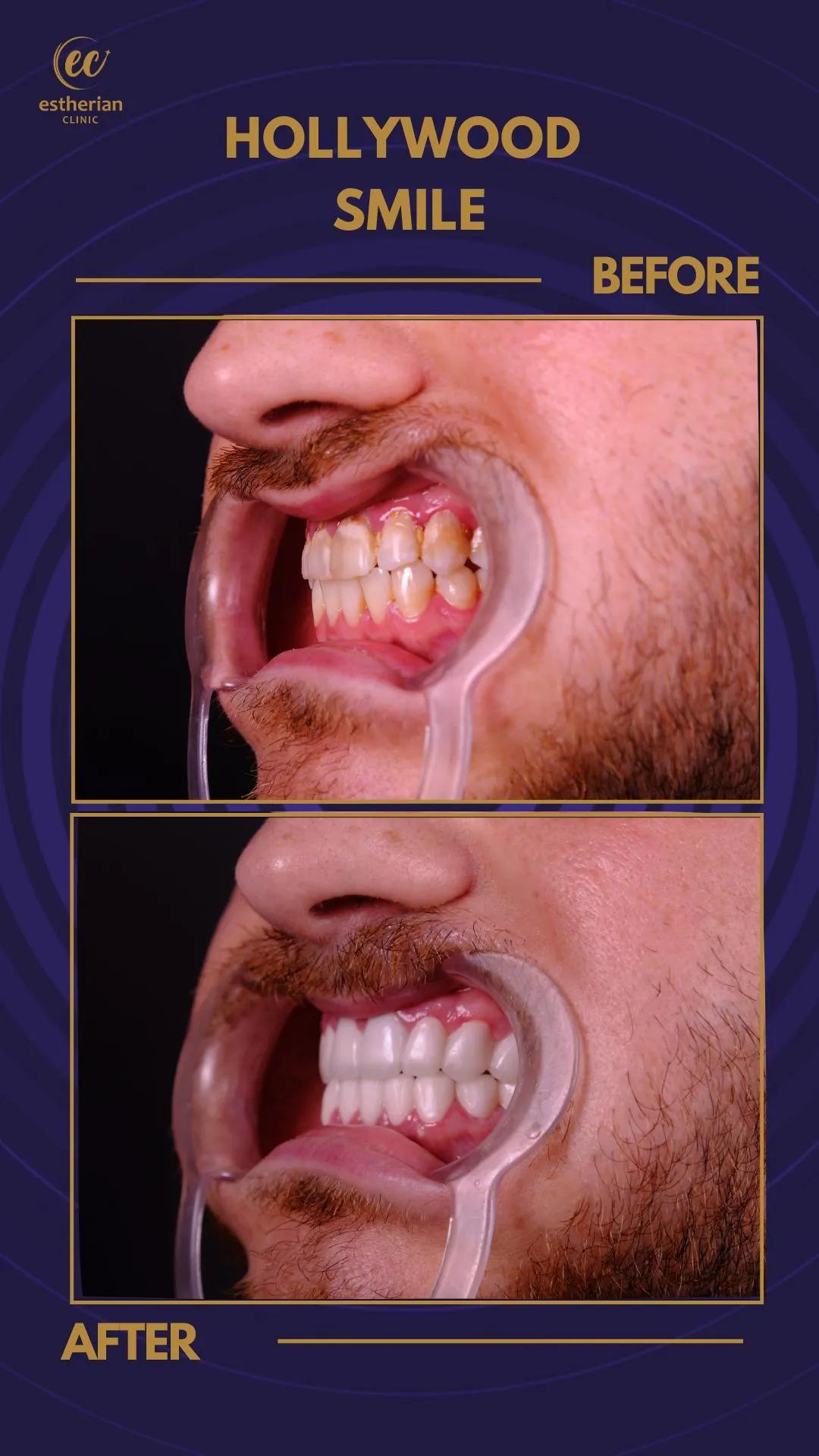 Cosmetic surgery Istanbul Before and after 9