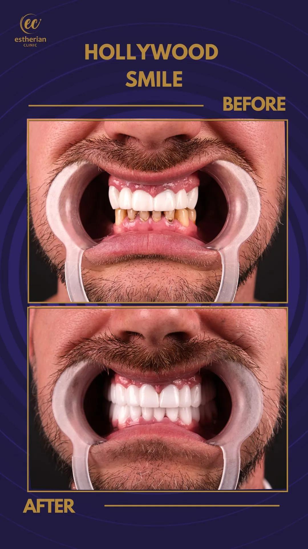 Cosmetic surgery Istanbul Before and after 10