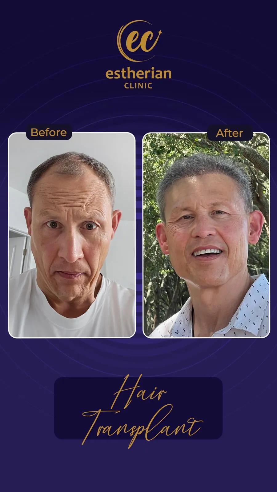 Cosmetic surgery Istanbul Before and after 5