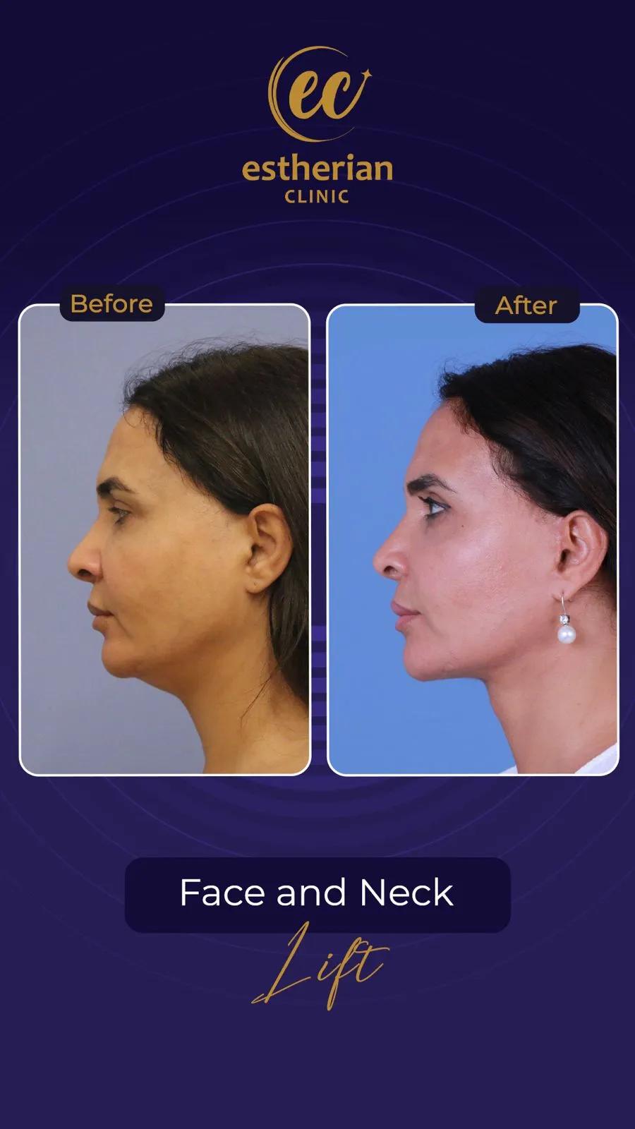 Cosmetic surgery Istanbul Before and after 11