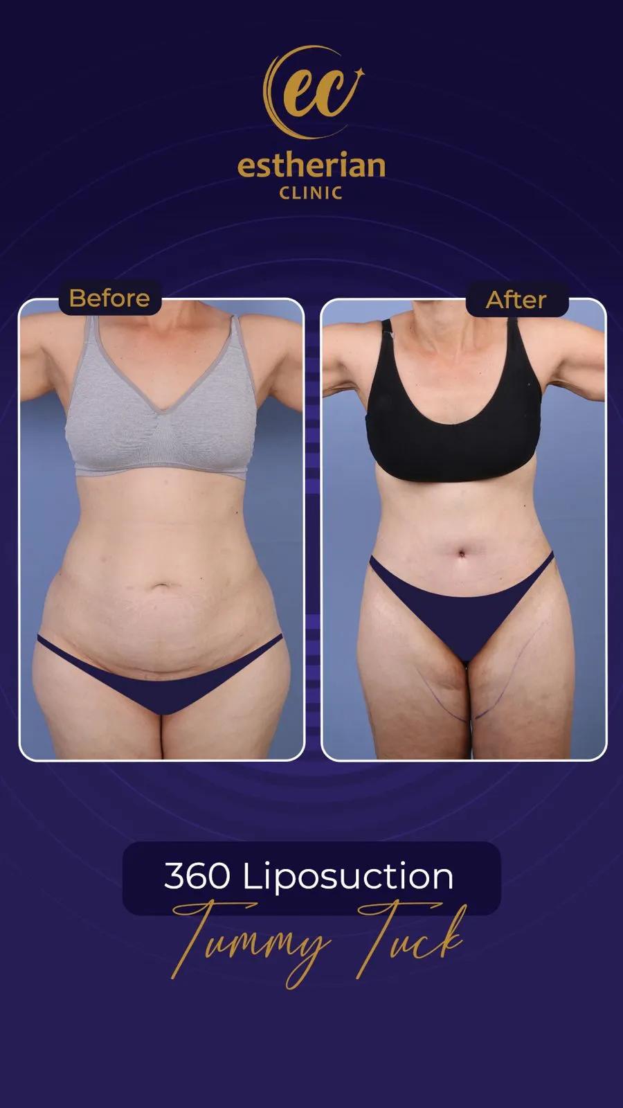 Cosmetic surgery Istanbul Before and after 17