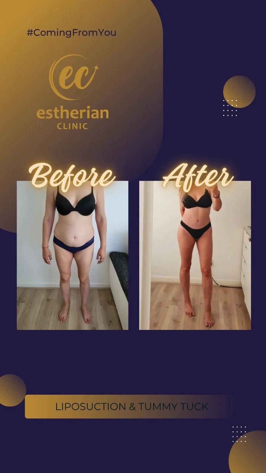 Cosmetic surgery Istanbul Before and after 18