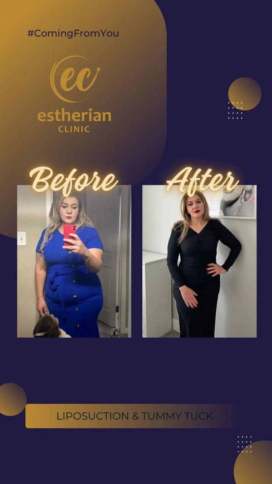 Cosmetic surgery Istanbul Before and after 19