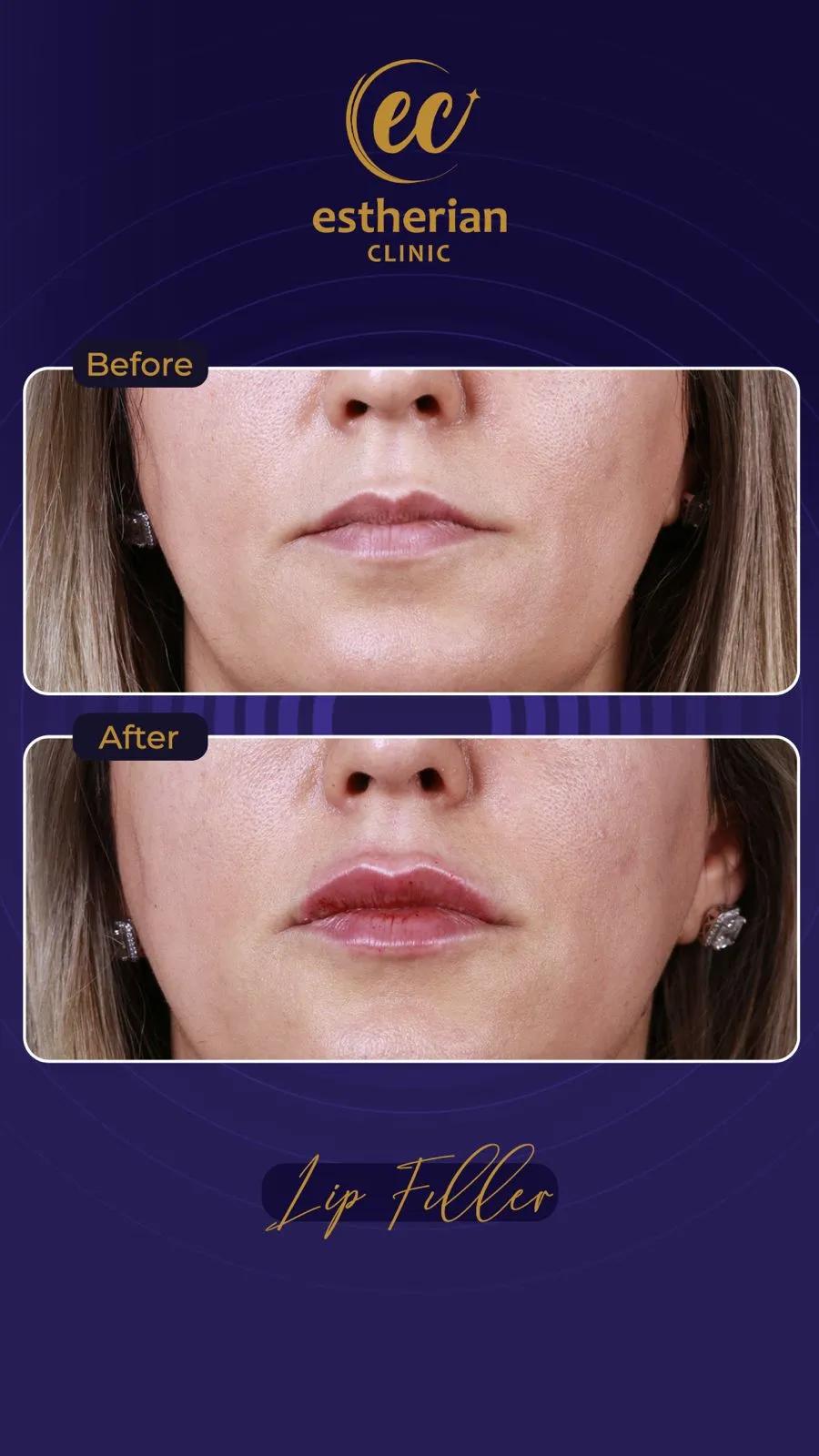 Cosmetic surgery Istanbul Before and after 13