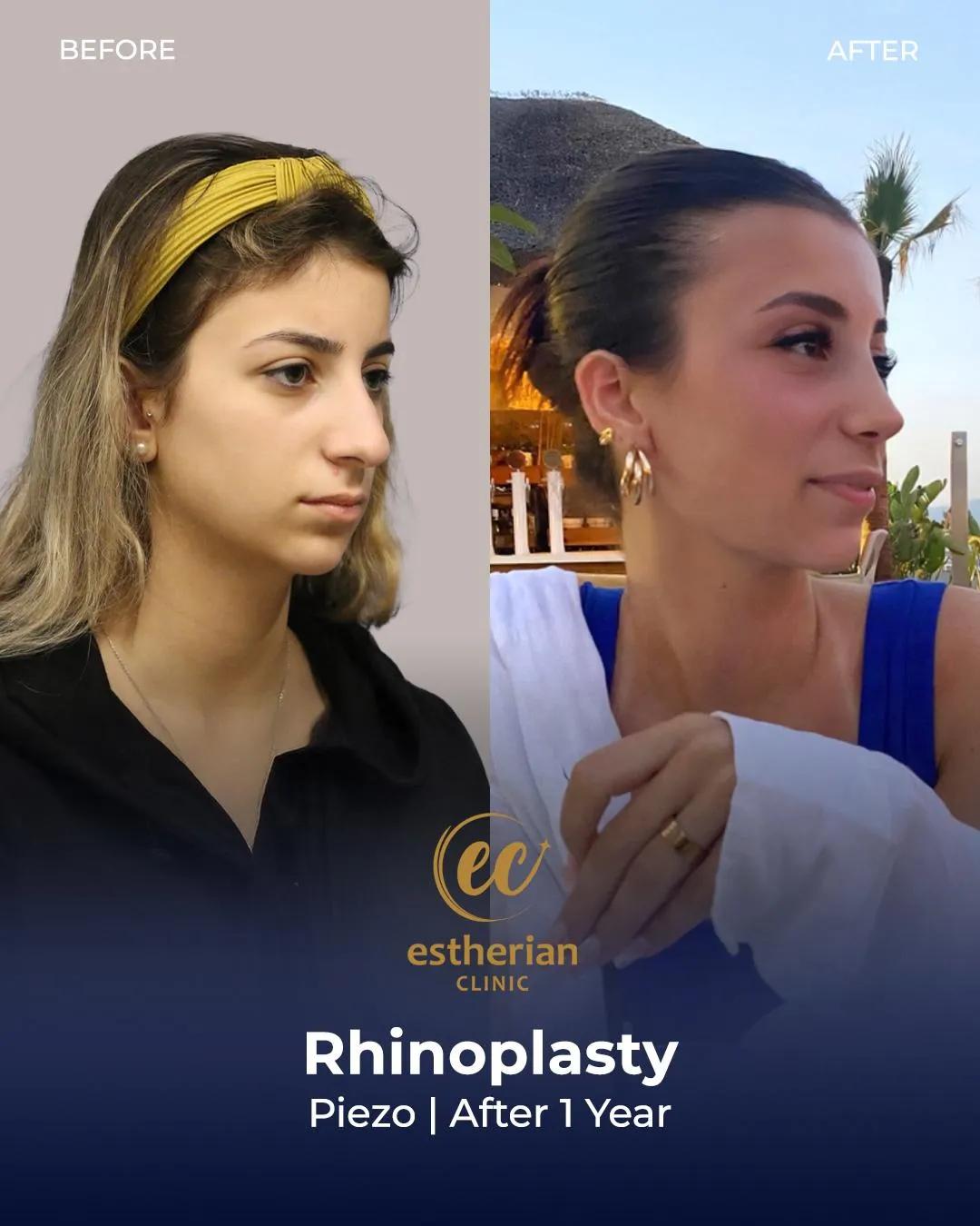 Estherian Clinic Istanbul results5