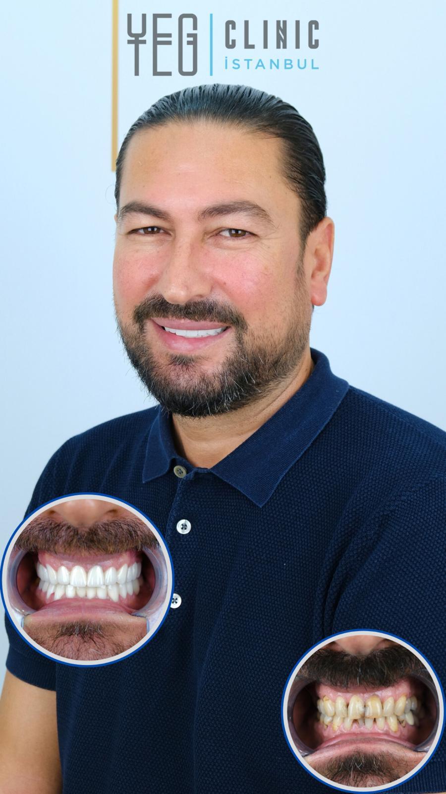 Yeg Clinic Istanbul Crowns X 20