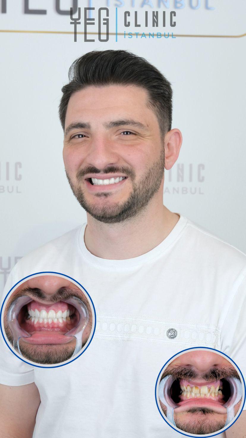 Yeg Clinic Istanbul Crowns X 20