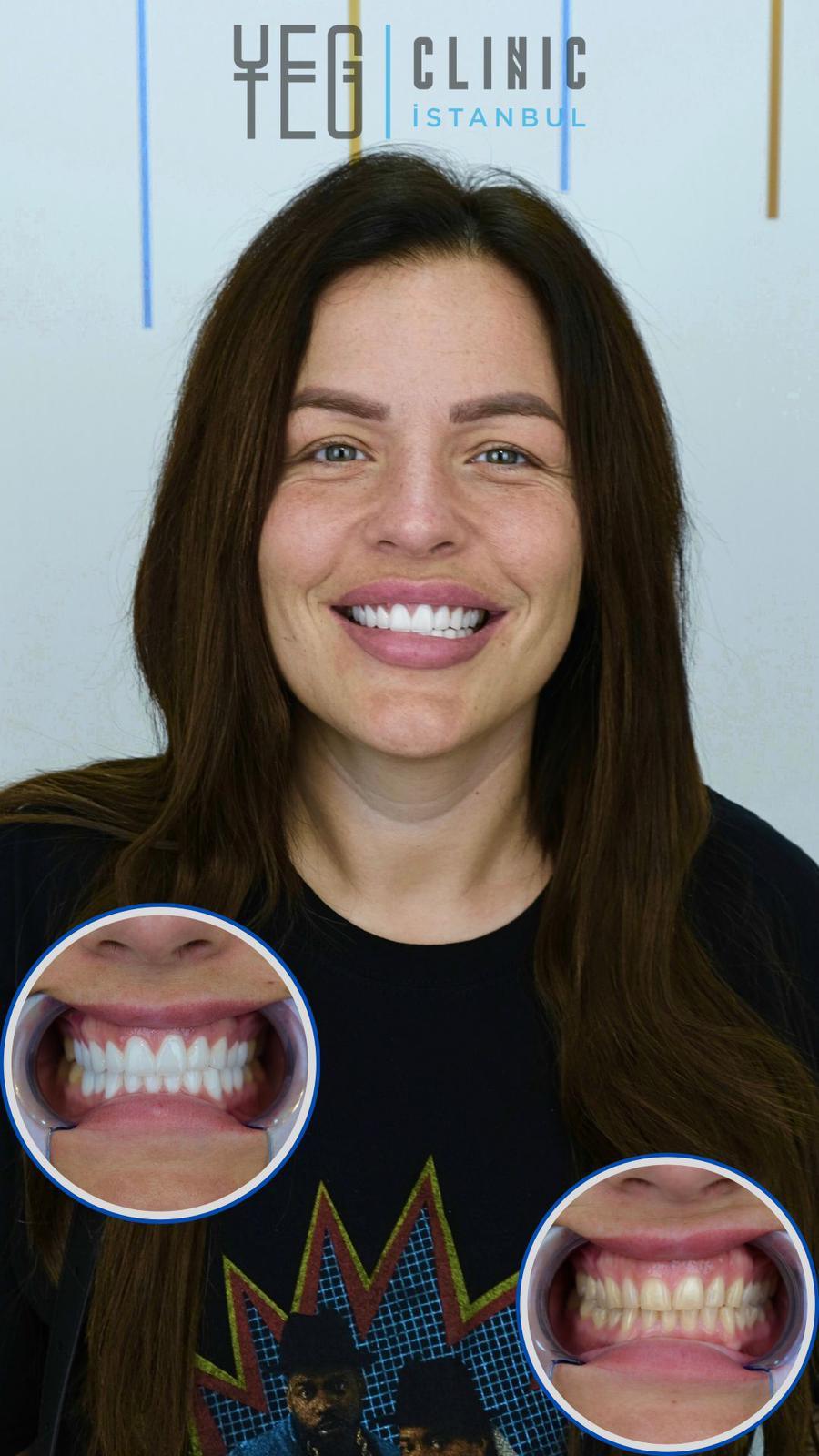 Yeg Clinic Istanbul Crowns X 20