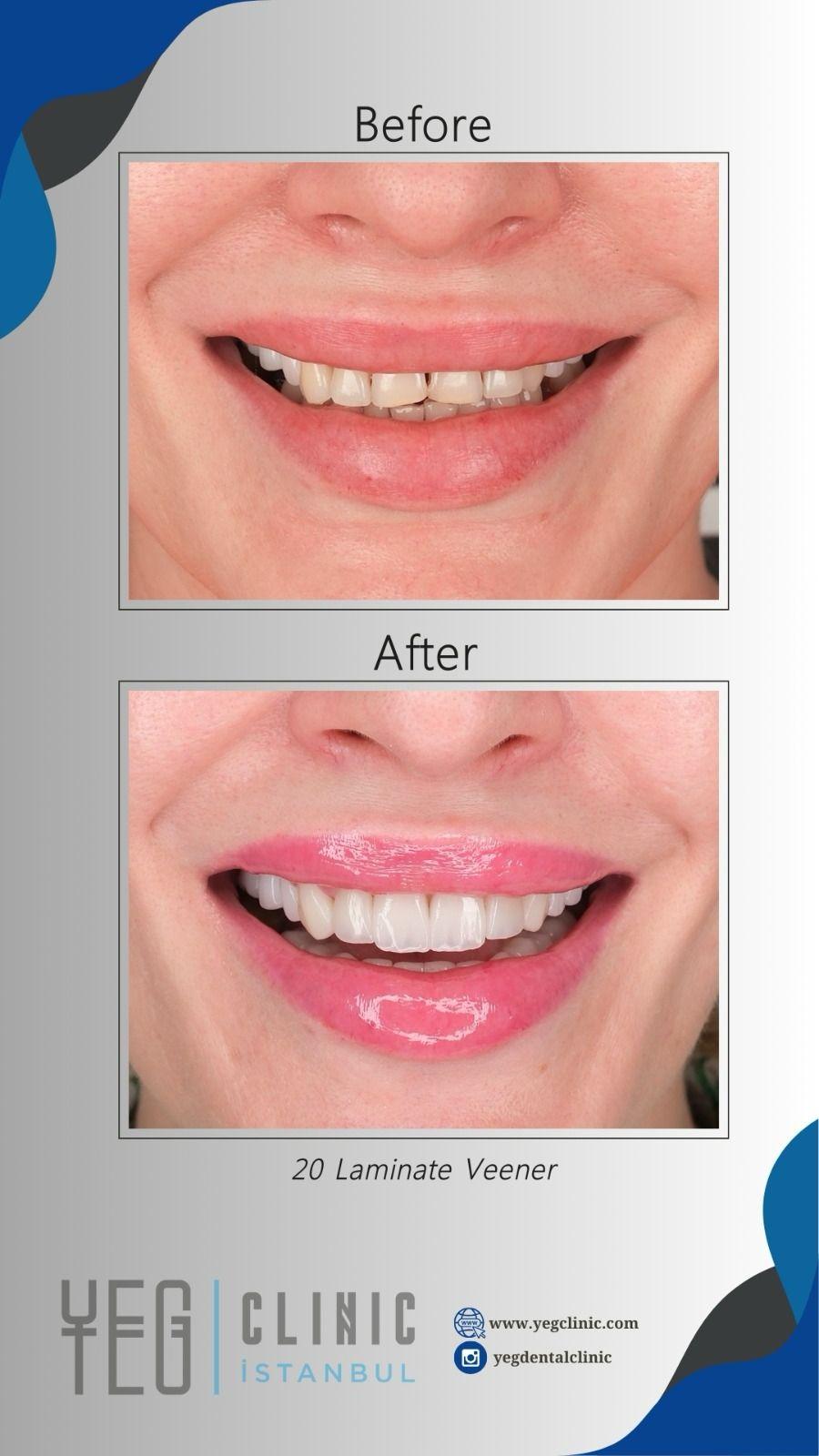 Emax Veneers