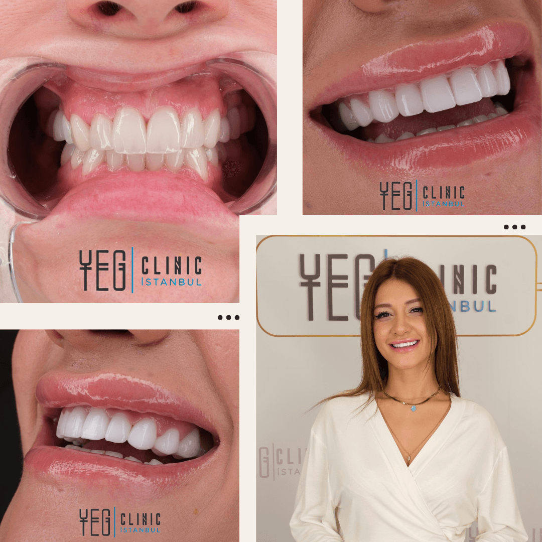 Emax Veneers