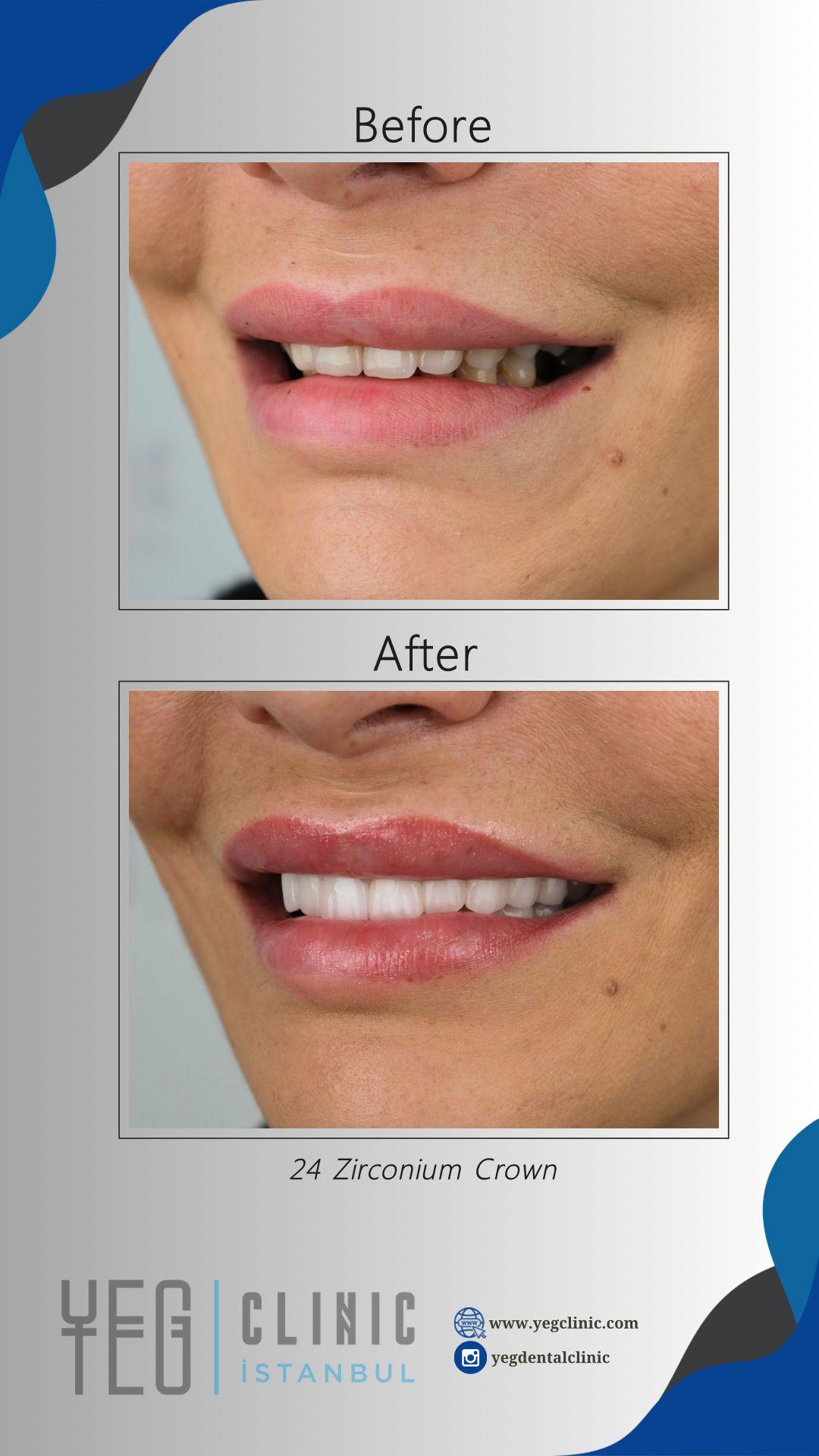 Emax Veneers