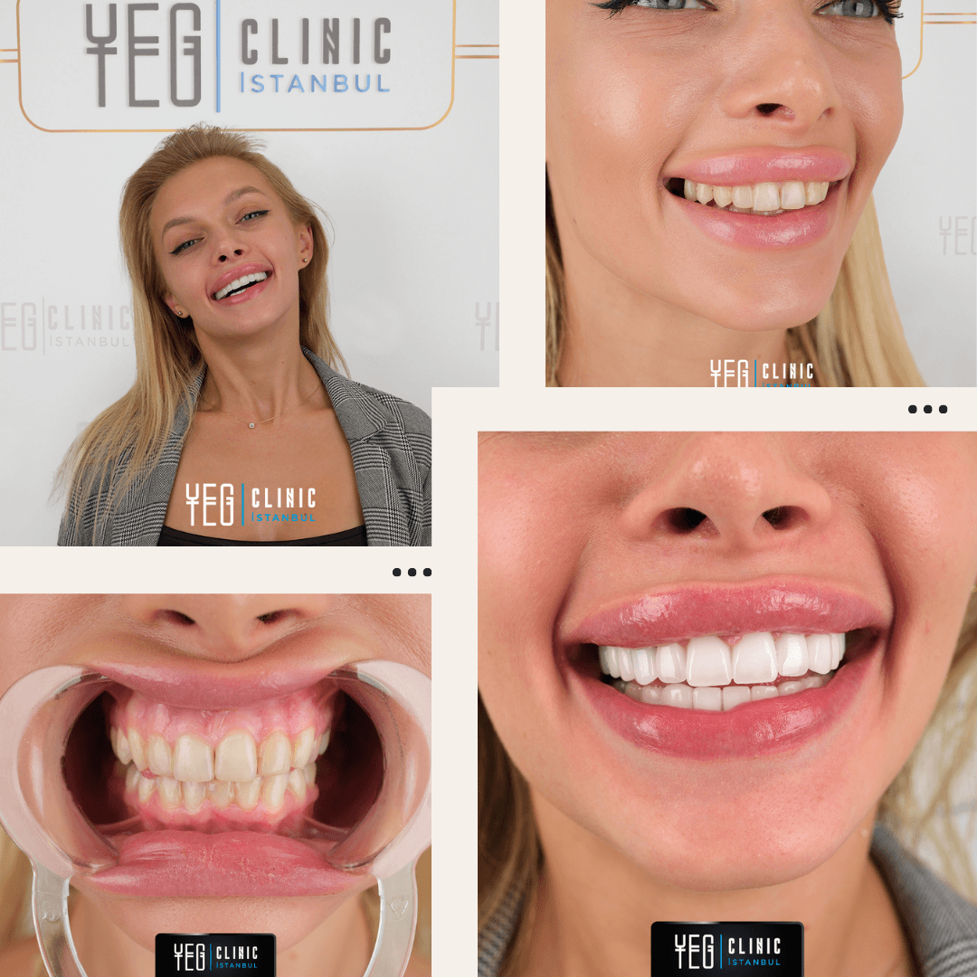 Emax Veneers