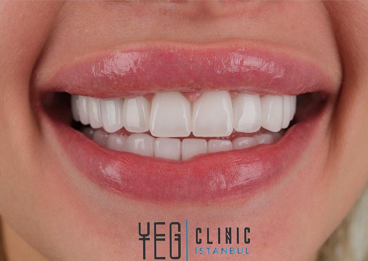 Emax Veneers