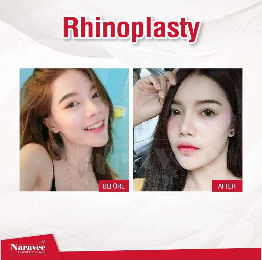 rhinoplastie-min