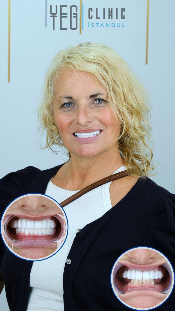 Dental implants