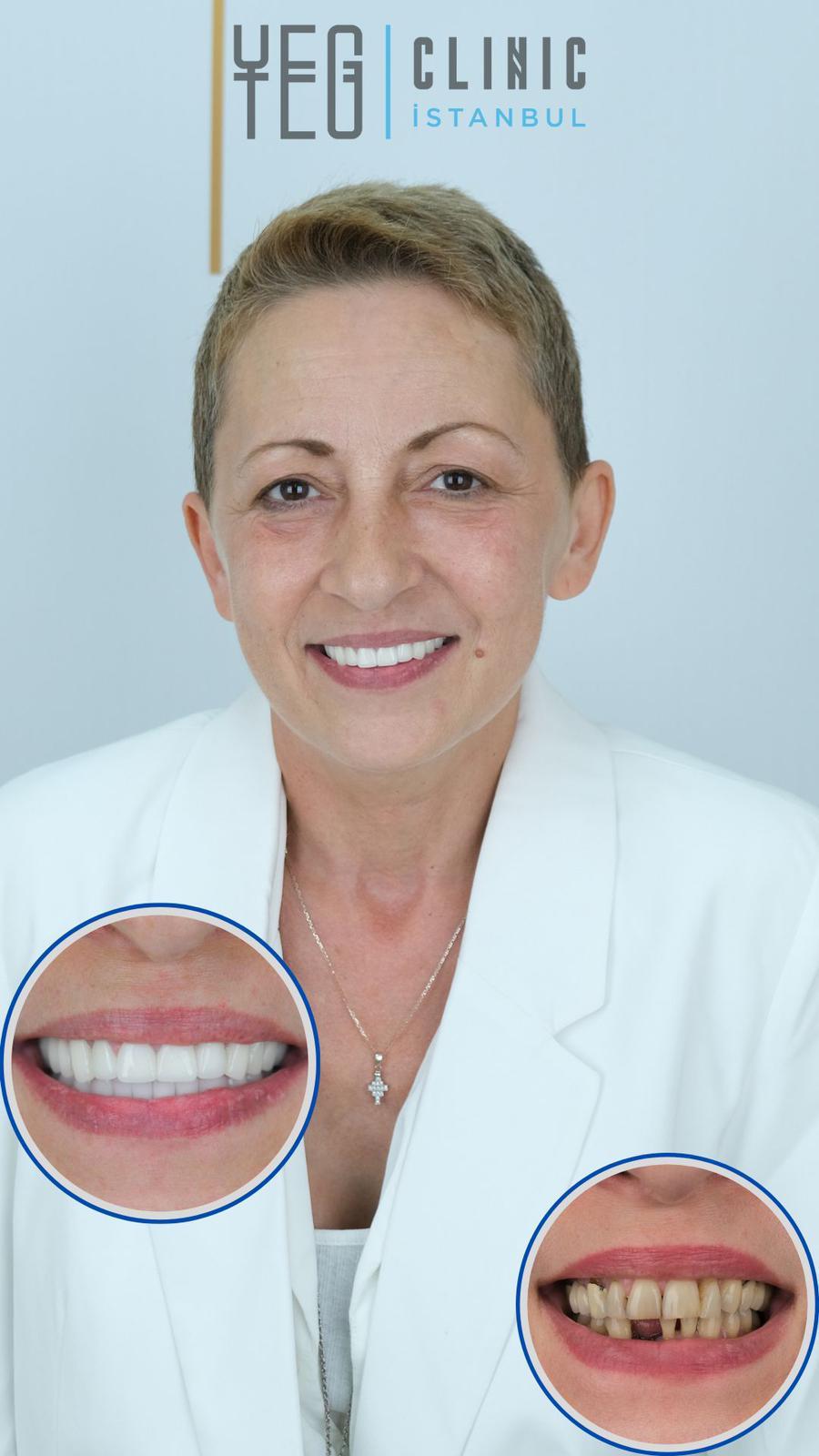 Dental implants