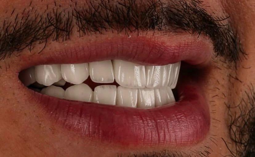 Dental Veneers