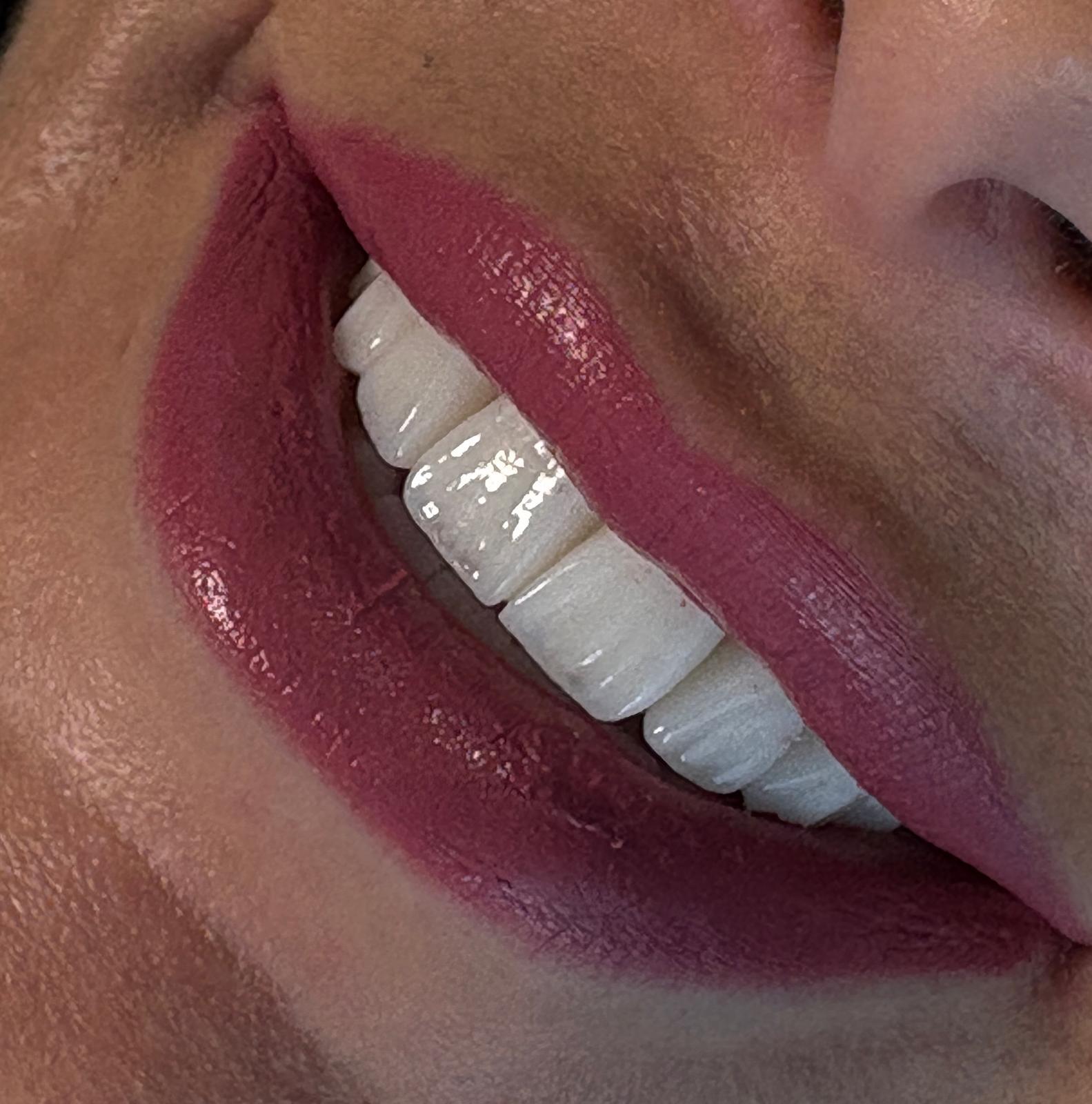 Dental Veneers