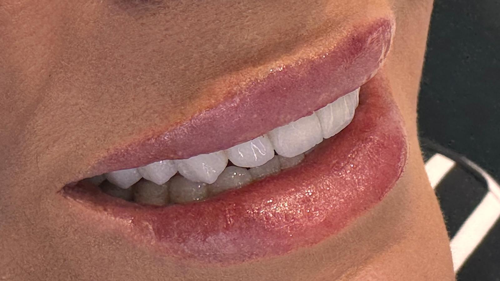 Dental Veneers