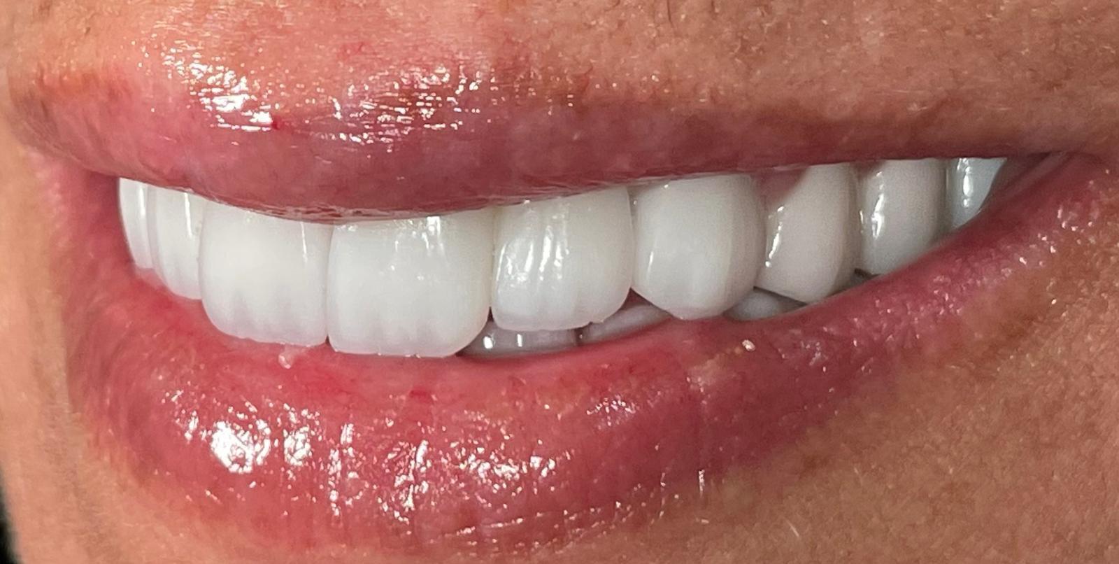 Dental Veneers
