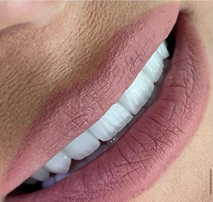 Emax Veneers