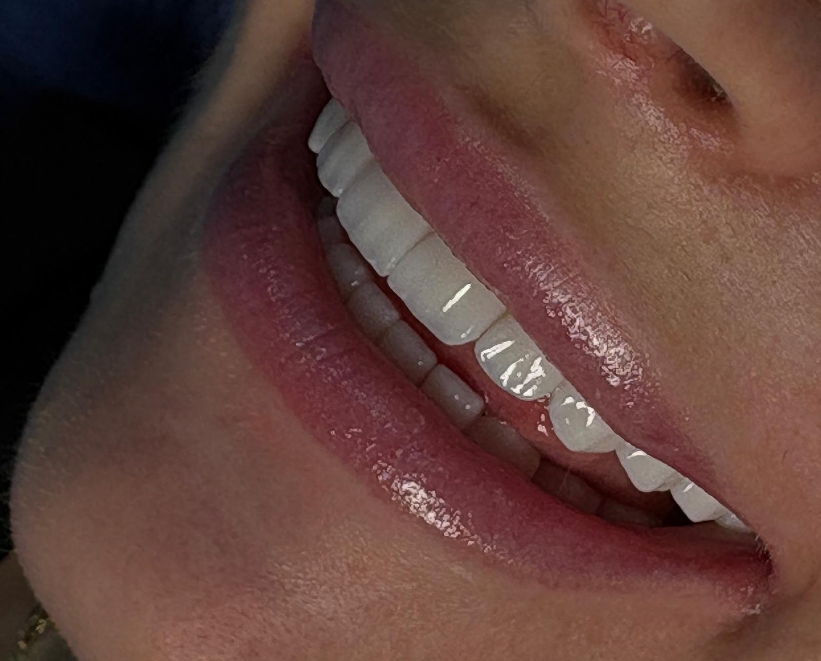 Emax Veneers