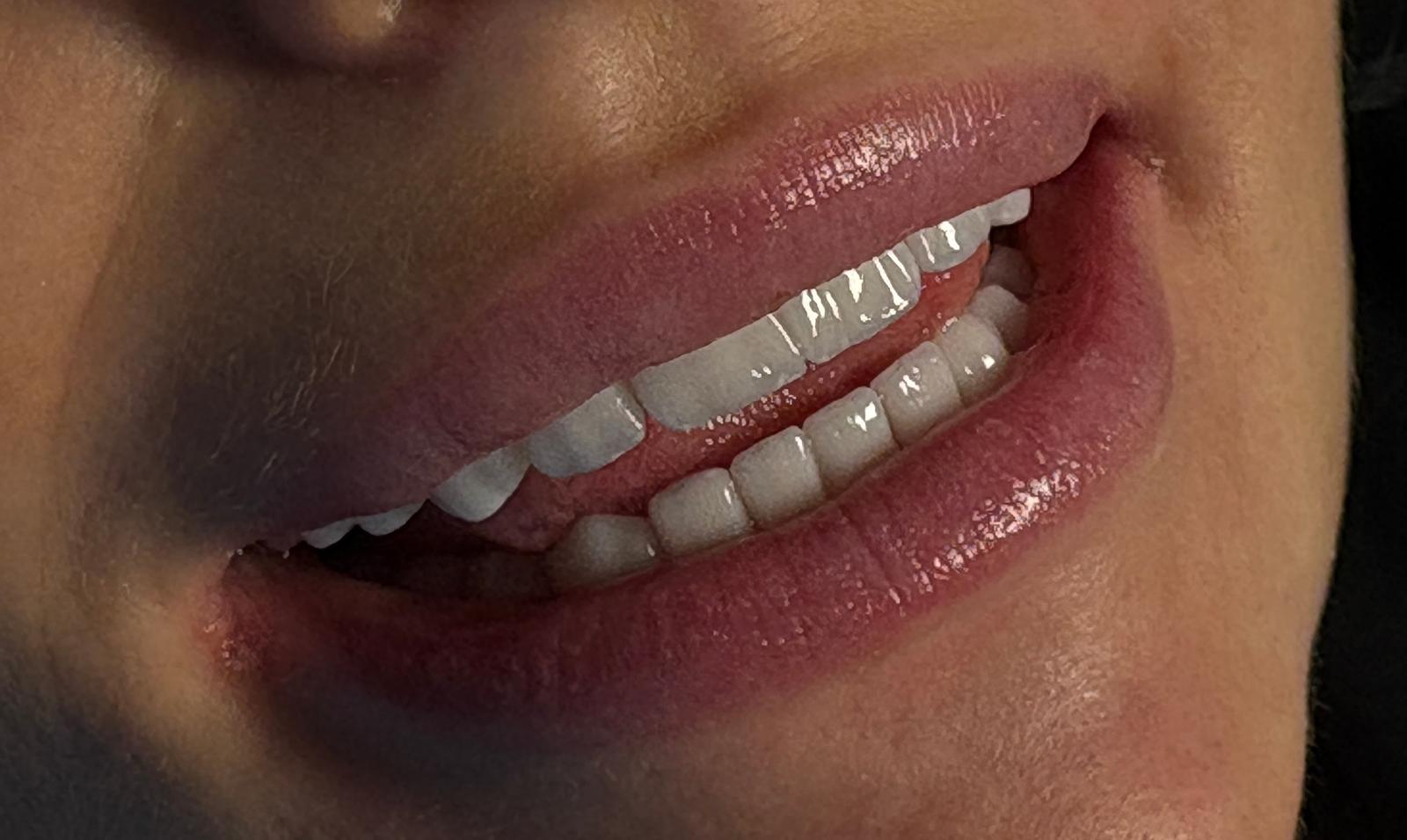 Emax Veneers