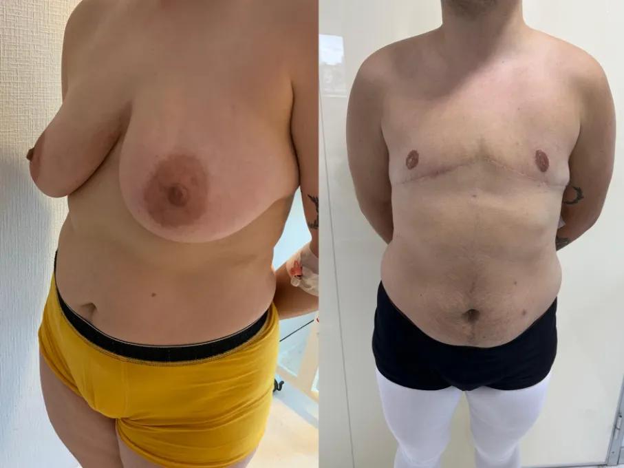 Mastectomy case 1_
