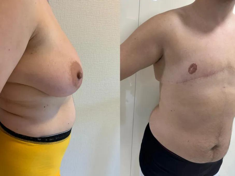Mastectomy case 1-2
