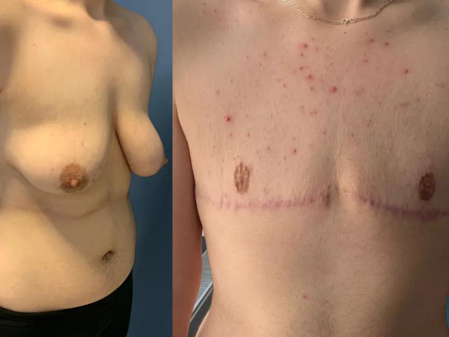 Mastectomy case 2-1