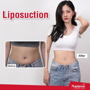 lipo-naravee-min