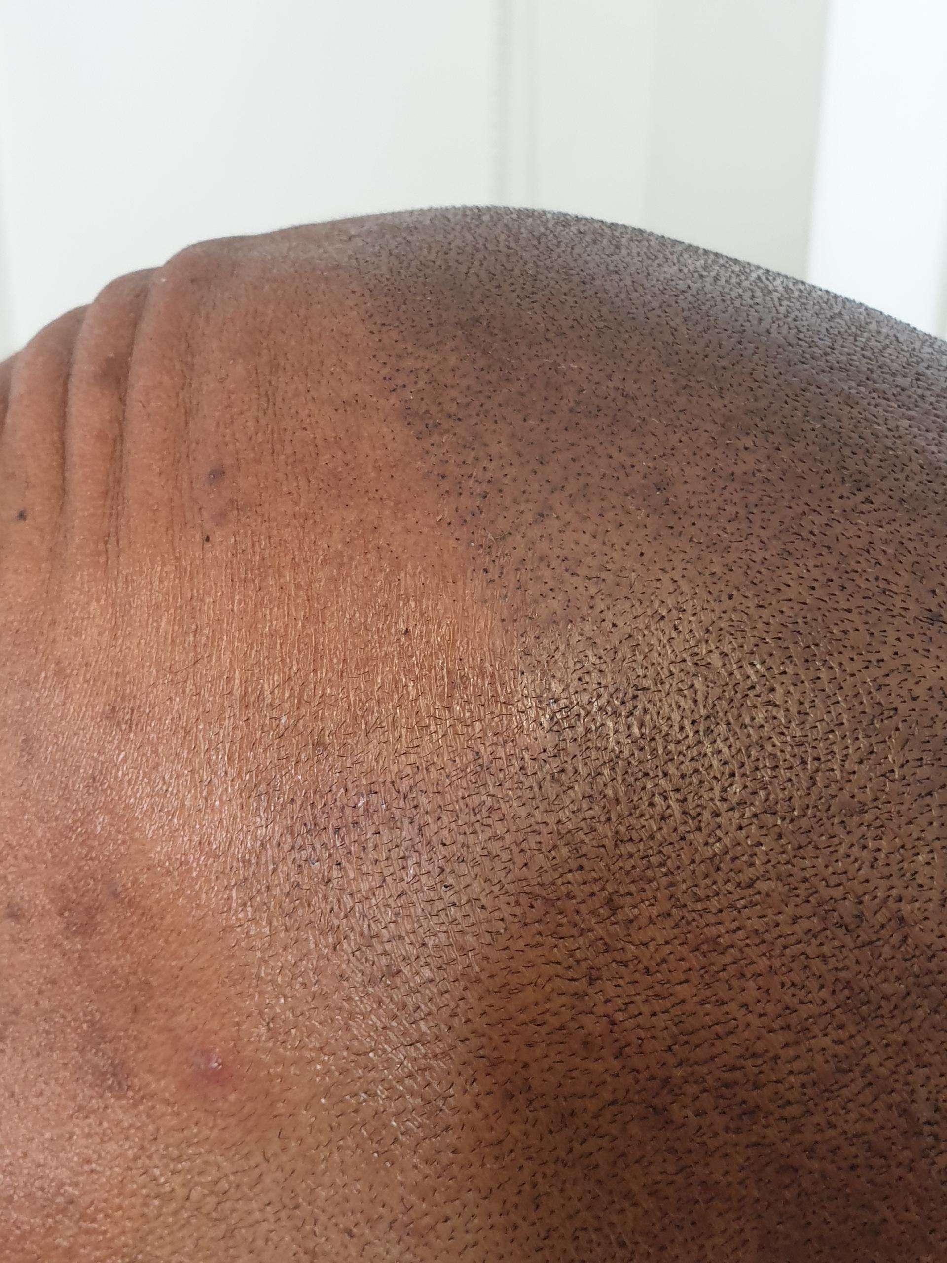 Scalp Micro Pigmentation result close up 