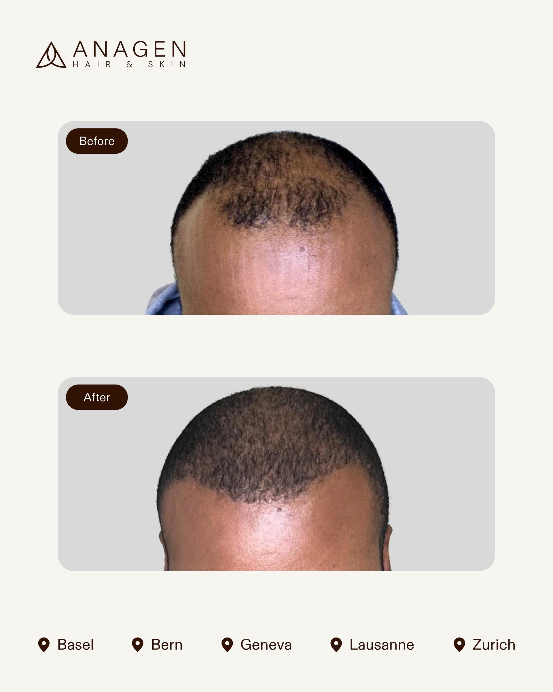 Anagen Clinic Hair transplant results
