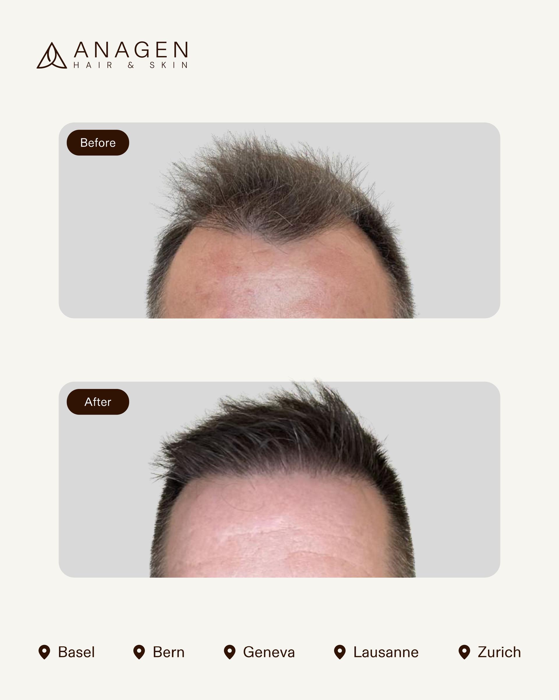 Anagen Clinic Hair transplant results