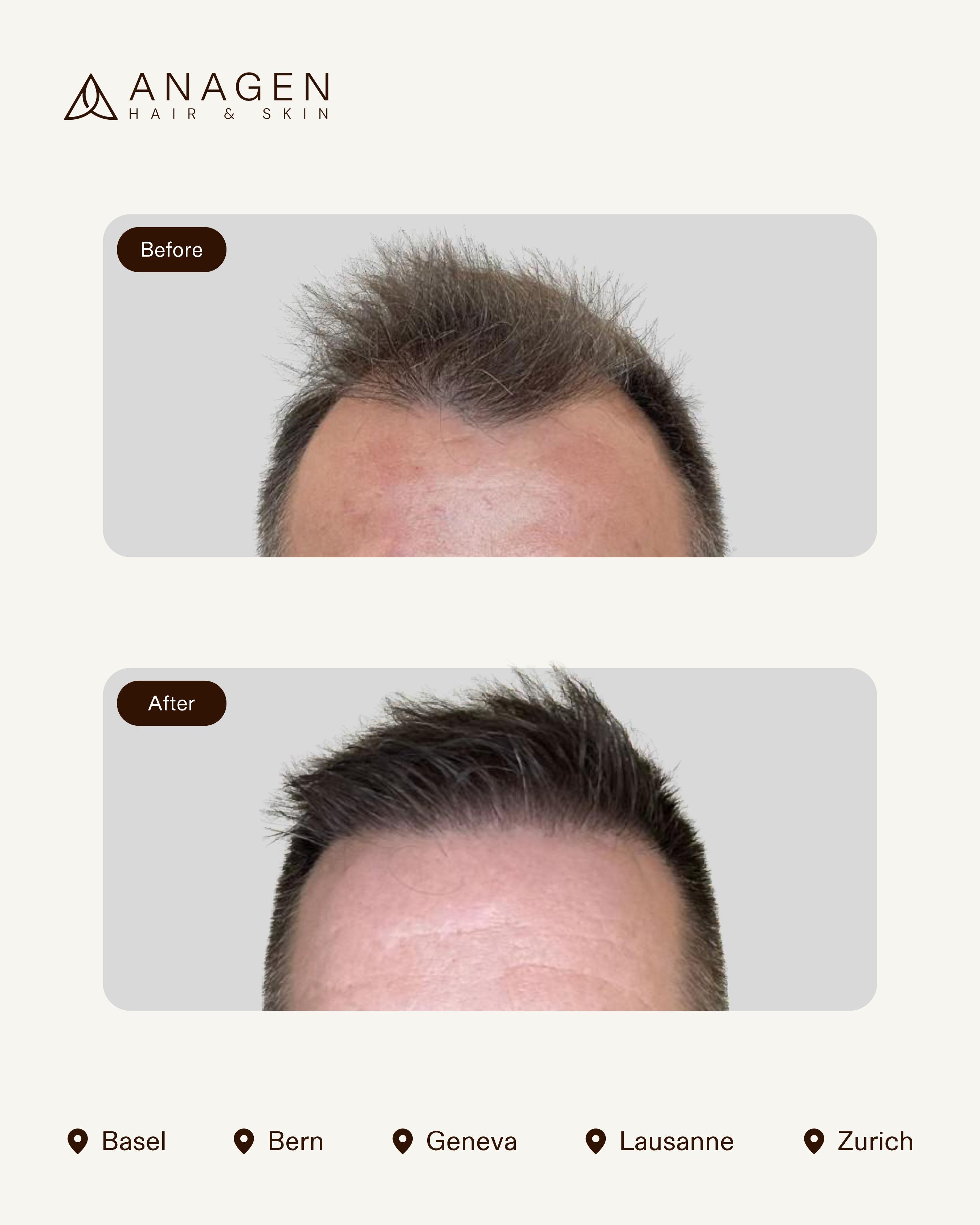 Anagen Clinic Hair transplant results