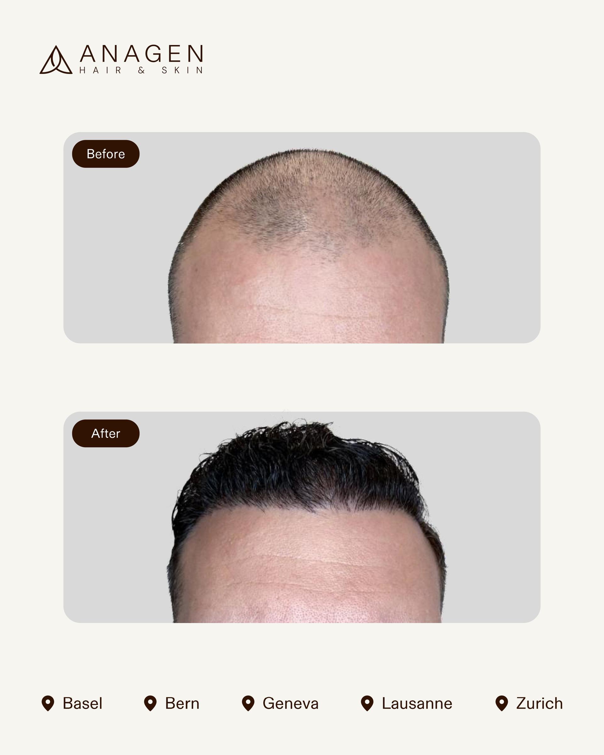 Anagen Clinic Hair transplant results