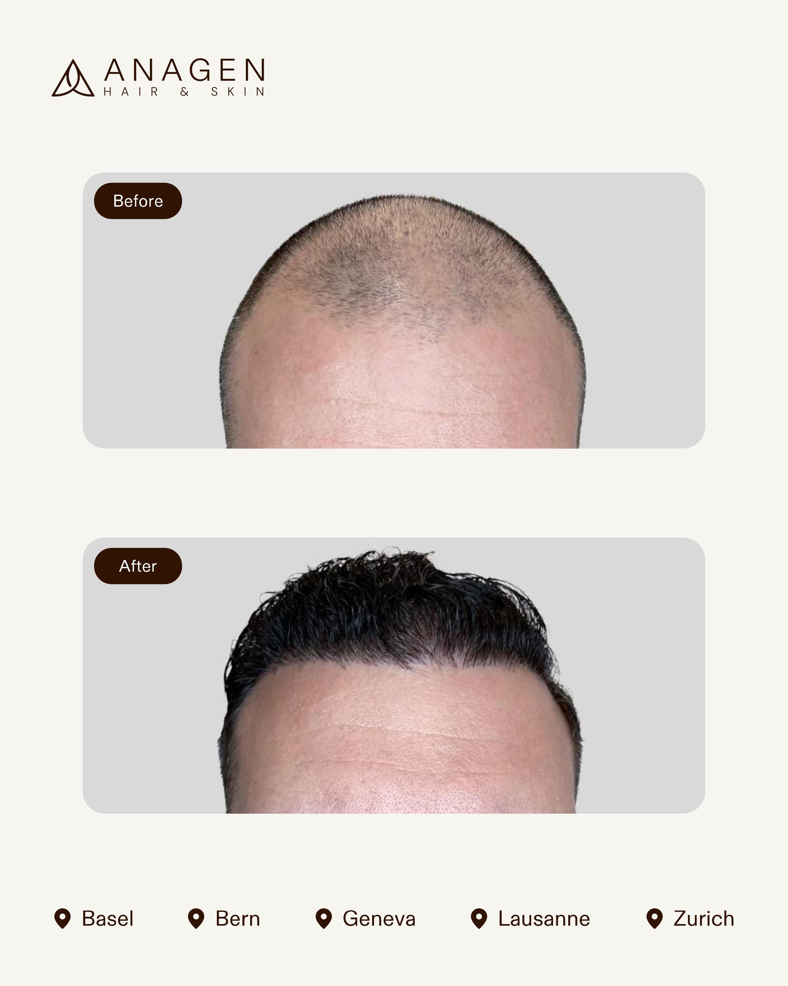 Anagen Clinic Hair transplant results