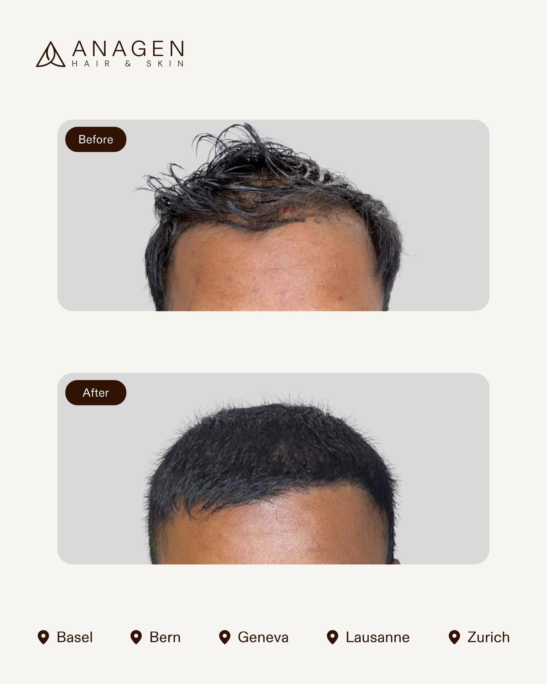 Anagen Clinic Hair transplant results