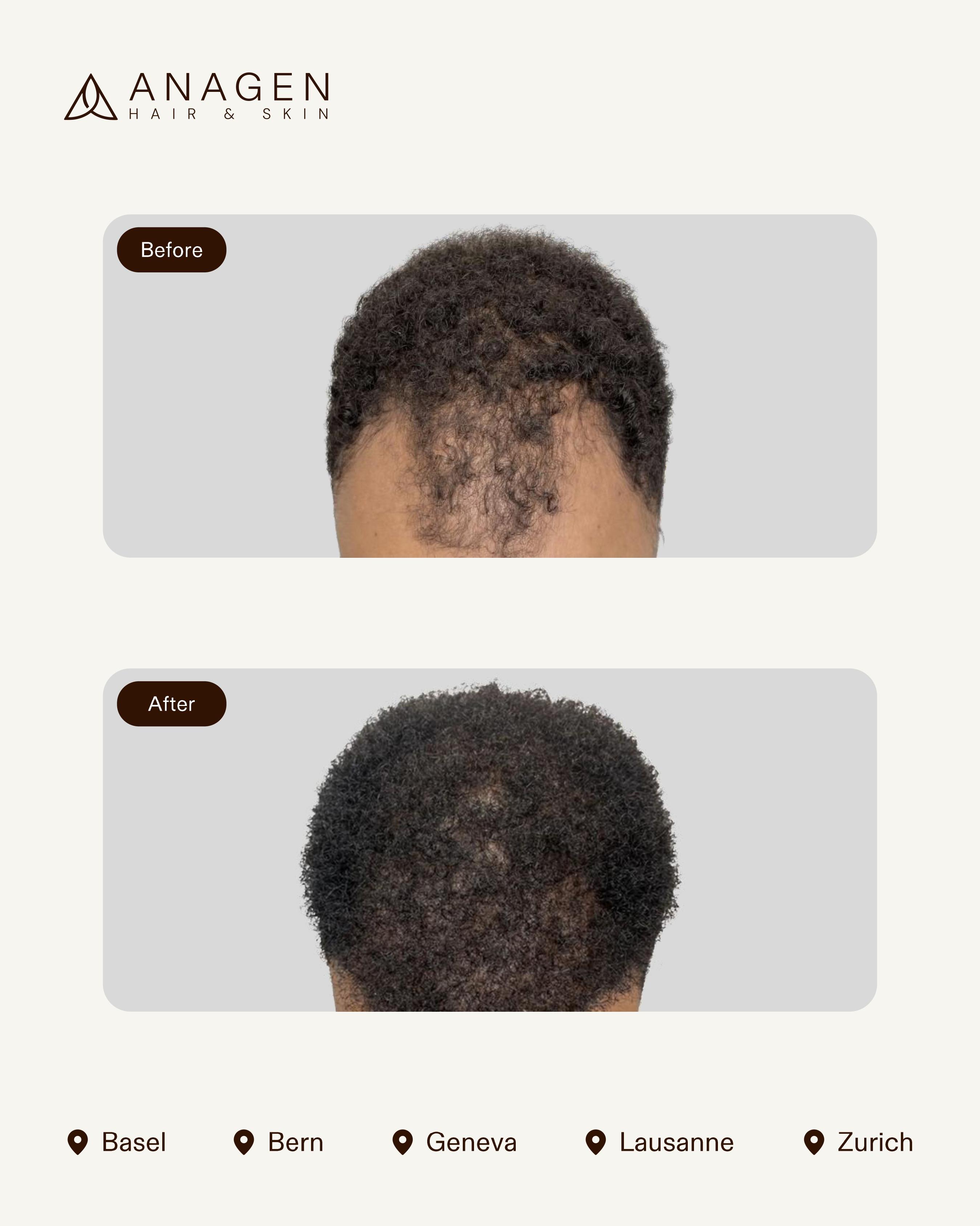 Anagen Clinic Hair transplant results