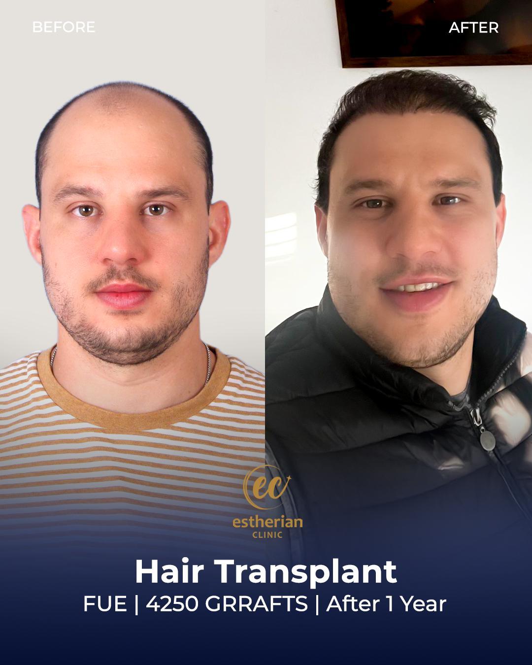 estherian Hair Surgery 7