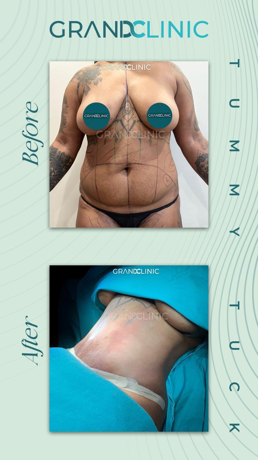 tummy tuck
