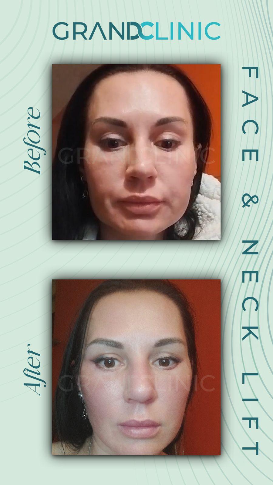 face lift surgery 