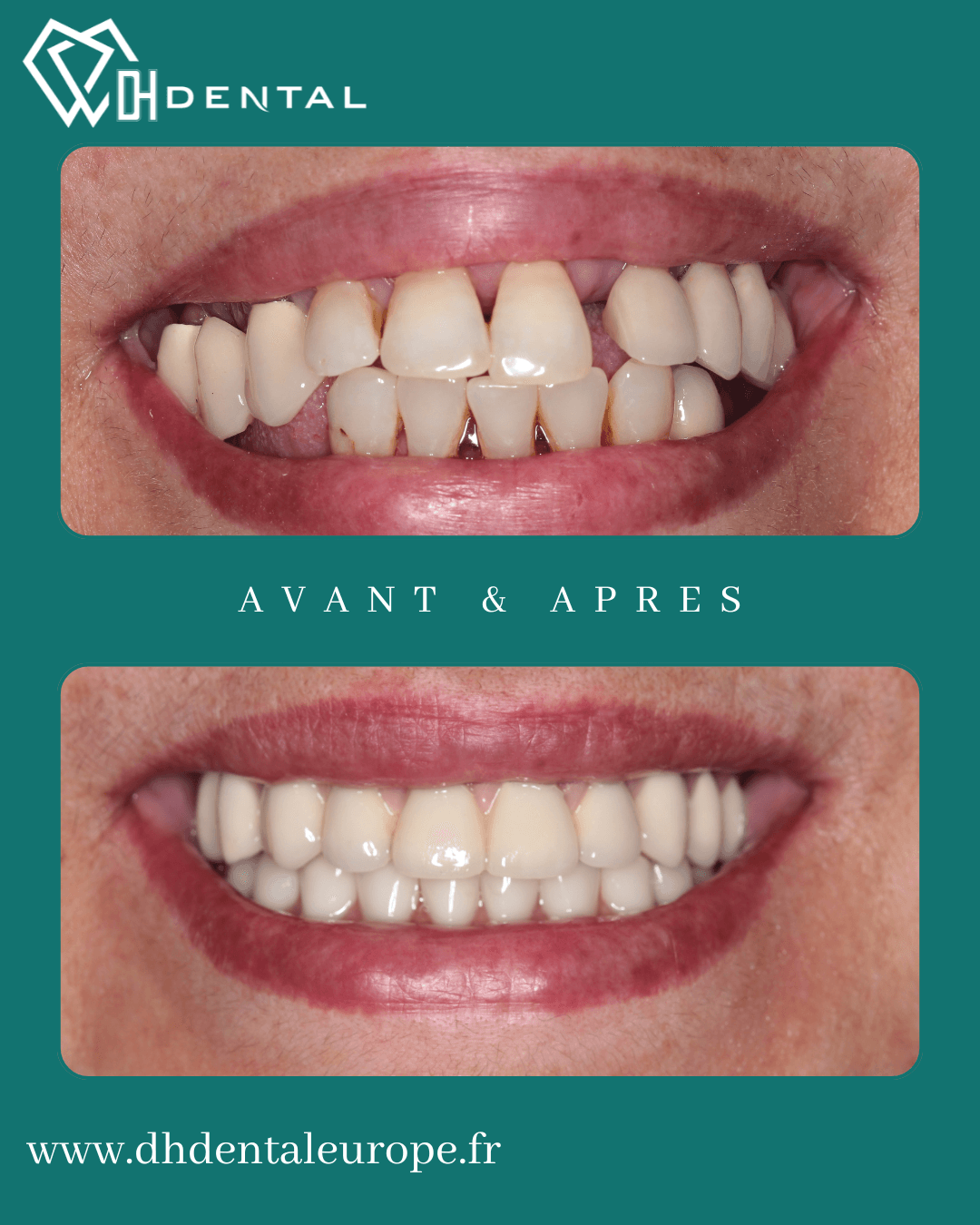 All-on-4 chez DH Dental