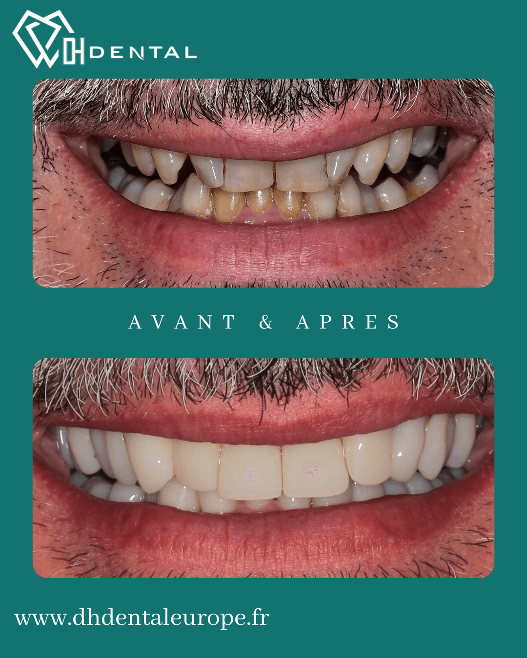 Couronnes zircones_DHDental (1)